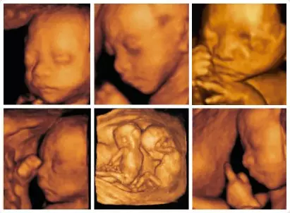 大畸形筛查可以查出胎儿所有的畸形吗？